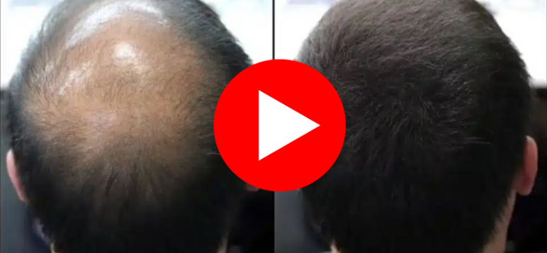 Watch the video about hair loss solution